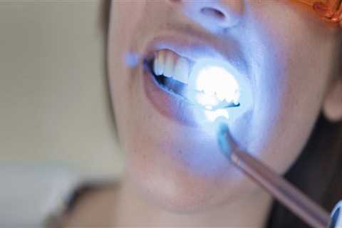 Teeth Whitening In Austin: The Perfect Choice For A Beautiful Smile