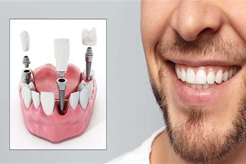 Are dental implants safe?