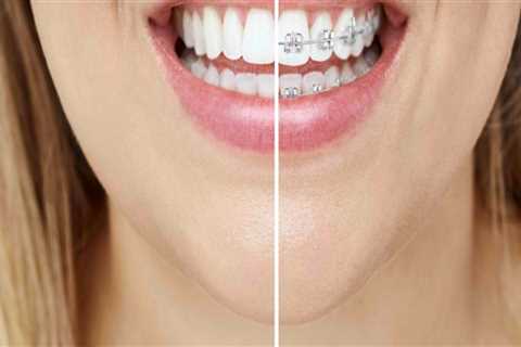 What Factors Determine the Cost of Invisalign Treatments?