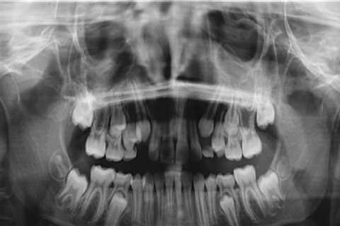 Do you really need panoramic dental x-rays?