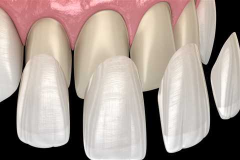 A Comprehensive Guide To Dental Veneers In Cedar Park: Is It Right For You