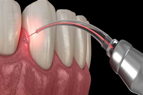 How To Get A Painless Dental Procedure With Laser Dentistry In Allen, TX