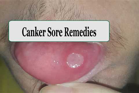 10 home remedies for Canker Sores - Home Remedies App