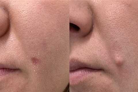 The Risks Associated with Non-Surgical Mole Removal Procedures: Changes in Skin Color at the..