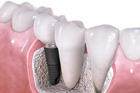 Standard post published to Symeou Dental Center at June 20, 2023 10:00