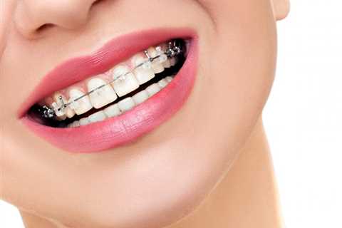 Understanding the Cost Breakdown of Braces