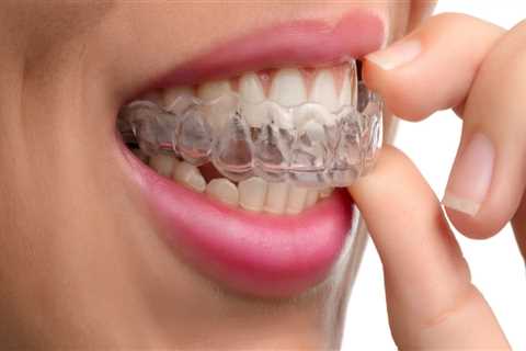 6 Steps to Get Invisalign Treatment from a Dentist