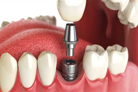 Which dental implants last the longest?