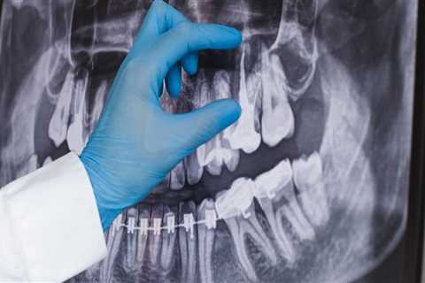 Why Dental X-Rays Are Essential Before Getting Dentures In Woden