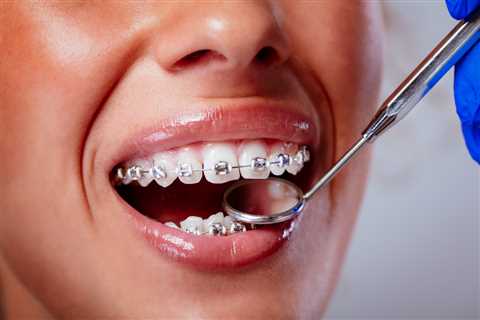 The Psychological Impact of Having Braces