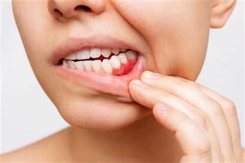 Reverse Receding Gums Causes