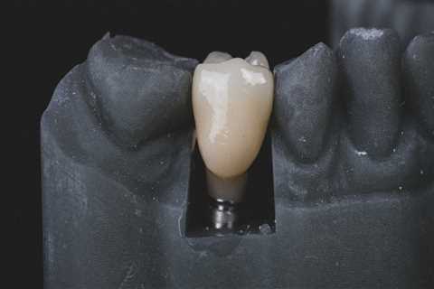 Can I Get a Dental Implant After Tooth Extraction?