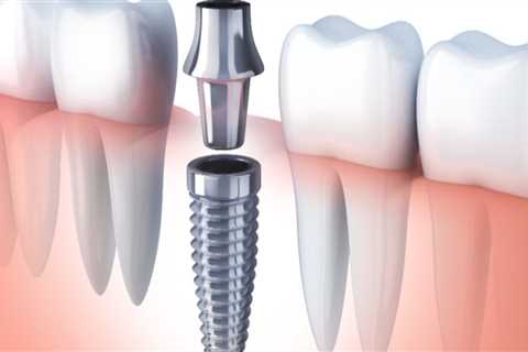 Why are Dental Implants So Unaffordable?