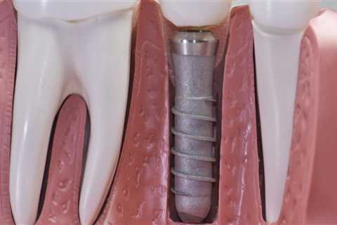 Can I Get a Dental Implant After Root Canal Treatment?