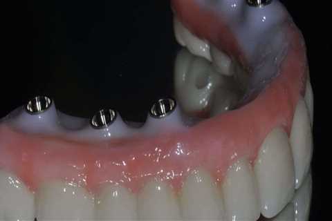 What is the Best Material for Teeth Implants?