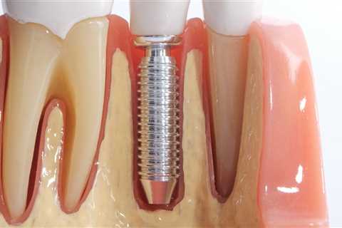 Success Rate of Teeth Implants: What You Need to Know