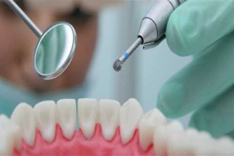 The Benefits of Electric Dental Drills in Dentistry