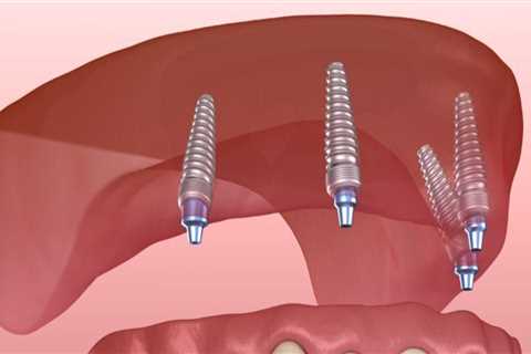 Do Dental Implants Need Regular Adjustments After Placement?