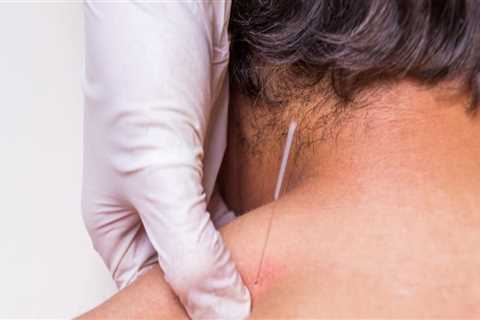 Acupuncture vs Dry Needling: Which is Better for Pain Relief?