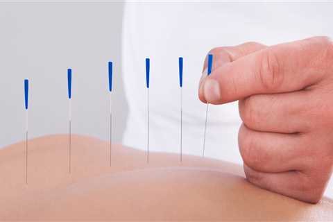 The Benefits of Acupuncture: A Comprehensive Guide