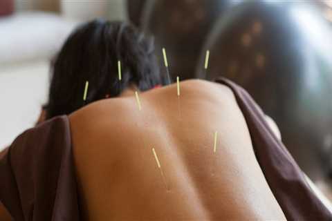 What Do You Need to Know Before Acupuncture Treatment?