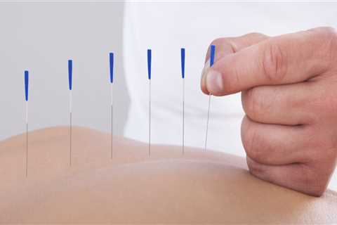 How Long Does Acupuncture Take to Work?