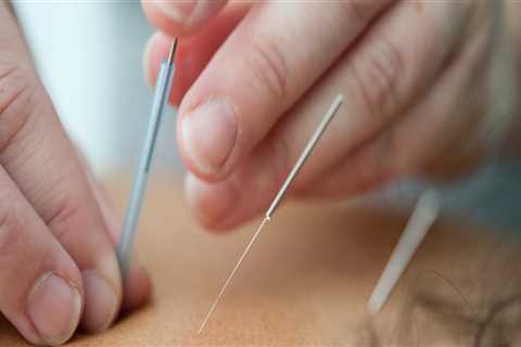 How Long Does an Acupuncture Session Last?