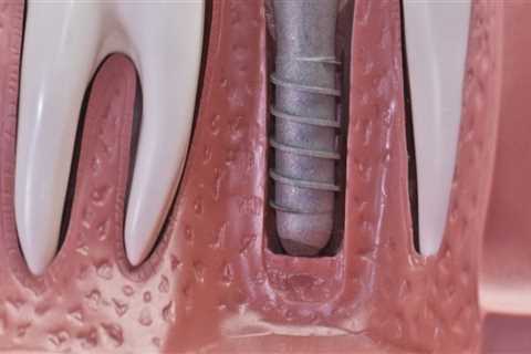 Can dental implants make you sick?