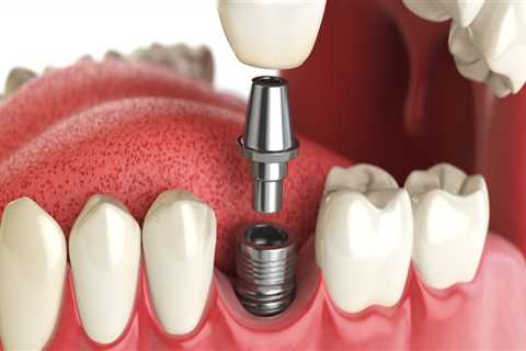 How To Choose The Best Dental Implant Specialist In London
