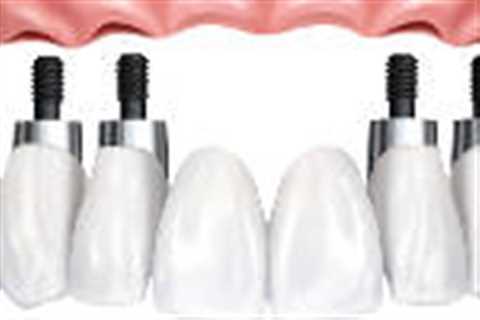 Tooth Replacement in Central London