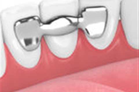 Dental Bridges