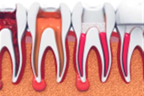 Root canal