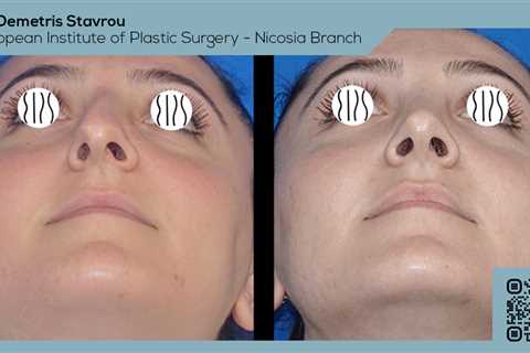 Standard post published to Dr. Demetris Stavrou - European Institute of Plastic Surgery - Nicosia..