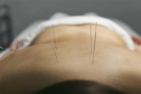 USING ACUPUNCTURE FOR CHRONIC LOWER BACK PAIN MANAGEMENT