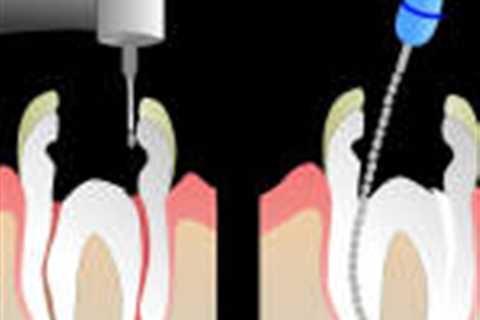 Root canal treatment