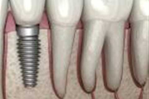 Implantology