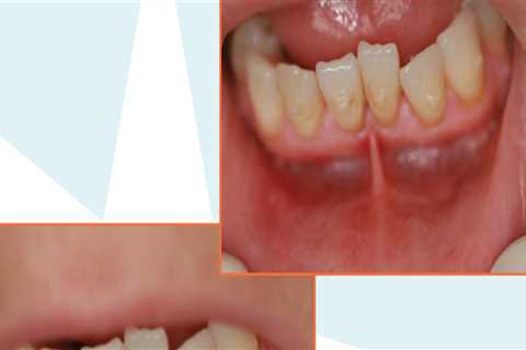 Maximizing Invisalign Results With Laser Dentistry In San Antonio