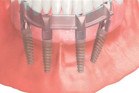 Smile Confidently Again With All-On-Four Dentures In Waco, TX