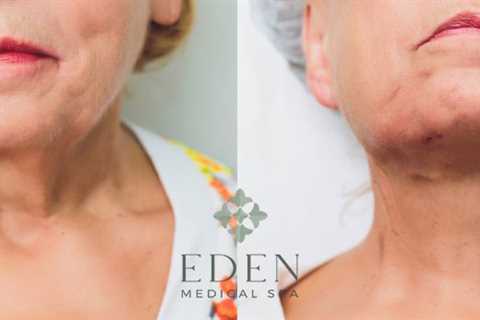 PDO Thread Lifts in Austin | Eden Med Spa