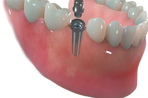 Revitalize Your Oral Health And Appearance With Dental Implants And Aesthetic Surgery In Austin, TX