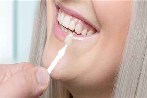 How often should veneers be replaced?