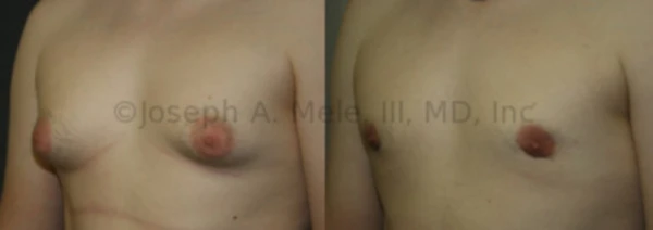 Gynecomastia Means Female Breasts so Why do Men Get Them?