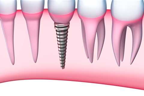 Achieve A Perfect Smile With Dental Implants: Unveiling The Journey Through Dental X-Rays In Austin,..