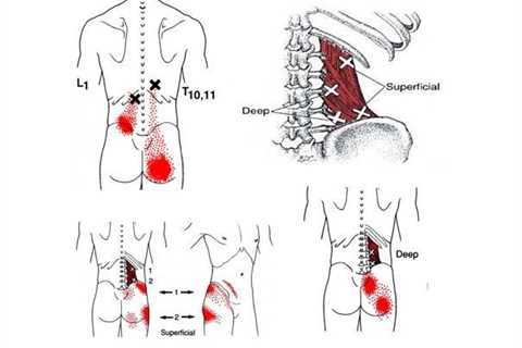 Low Back Trigger Points - Pain Relief Techniques