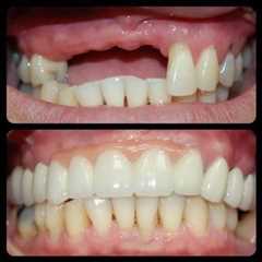 Let's replace those missing teeth....  Call/WhatsApp us on 0823900130 visit any…