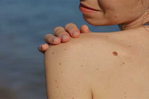 A Guide to Melanoma: What to Look For, Treatment, and More