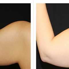 What is laser liposuction cost?