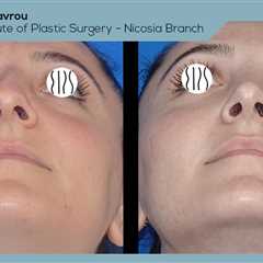 Standard post published to Dr. Demetris Stavrou - European Institute of Plastic Surgery - Nicosia..