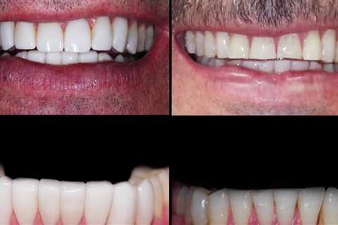 Can you get veneers for your bottom teeth?