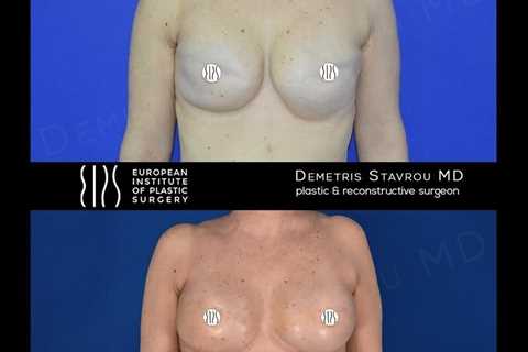 Standard post published to Dr. Demetris Stavrou - European Institute of Plastic Surgery - Nicosia..